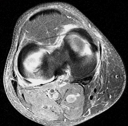 Figure 4 for case Unstable flap tear medial meniscus